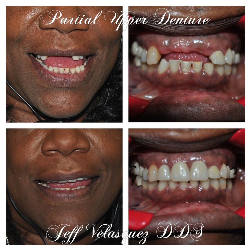 upper front teeth